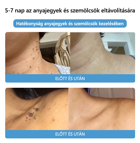 🌈🌈🧴[👑Hivatalos márkabolt👑] LEFUN™ méhméreg vakond- és szemölcskezelő krém (👨‍⚕AAD AJÁNLOTT)