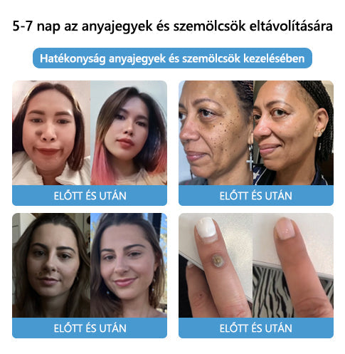 🌈🌈🧴[👑Hivatalos márkabolt👑] LEFUN™ méhméreg vakond- és szemölcskezelő krém (👨‍⚕AAD AJÁNLOTT)