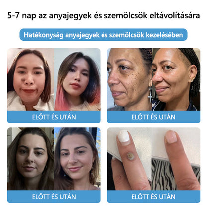 🌈🌈🧴[👑Hivatalos márkabolt👑] LEFUN™ méhméreg vakond- és szemölcskezelő krém (👨‍⚕AAD AJÁNLOTT)