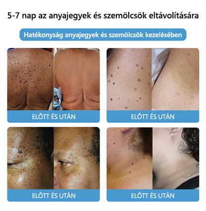 [👑Hivatalos zászlóshajó üzlet👑] LEFUN™ Méhméreg anyajegy és szemölcs kezelési krém(👨‍⚕AAD AJÁNLJA)5