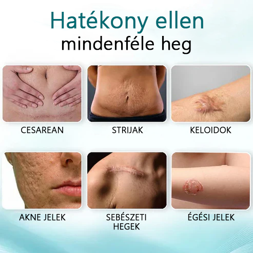 ✨✨Advanced 💧LEFUN™ Scar spray Minden típusú hegre - például aknés hegek, műtéti hegek és striák ellen.