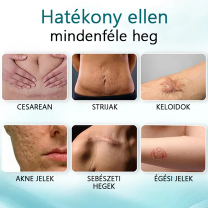 ✨✨Advanced 💧LEFUN™ Scar spray Minden típusú hegre - például aknés hegek, műtéti hegek és striák ellen.