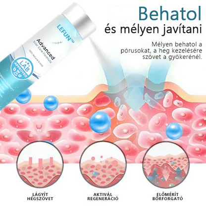 ✨✨Advanced 💧LEFUN™ Scar spray Minden típusú hegre - például aknés hegek, műtéti hegek és striák ellen.