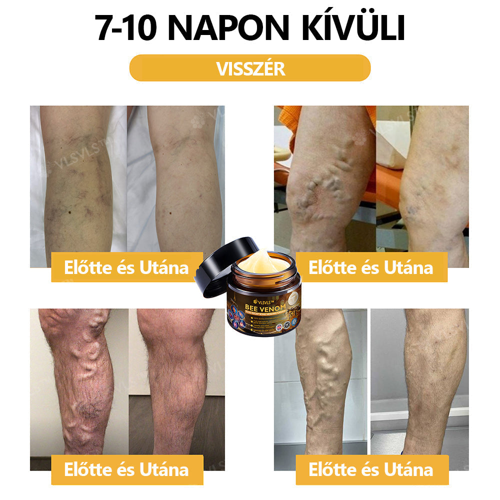 Hivatalos áruház:  🦵VLSVLS™ Méhméreg Arthritis terápiás krém(Kifejezetten az idősebb felnőttek számára & az AAOS ajánlja)🔥Utolsó nap promóció 70% le x💖💖