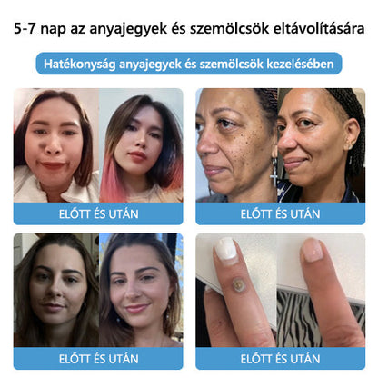 🎉🎉🎉[🍀 Hivatalos zászlóshajó üzlet 🍀] Lenaro™ Méhméreg vakond és szemölcs kezelési krém(👨‍⚕AAD AJÁNLJA)